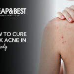 How To Cure Back Acne In Your Body?