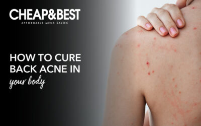 How To Cure Back Acne In Your Body?