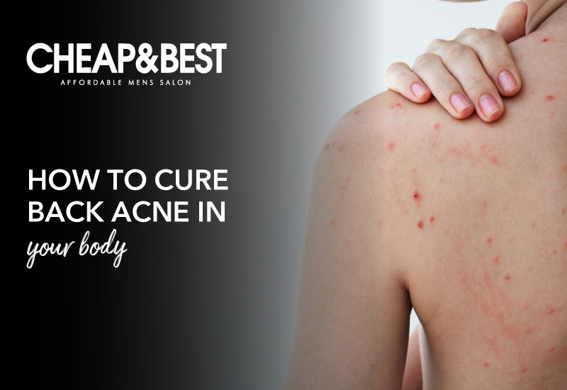 How To Cure Back Acne In Your Body?
